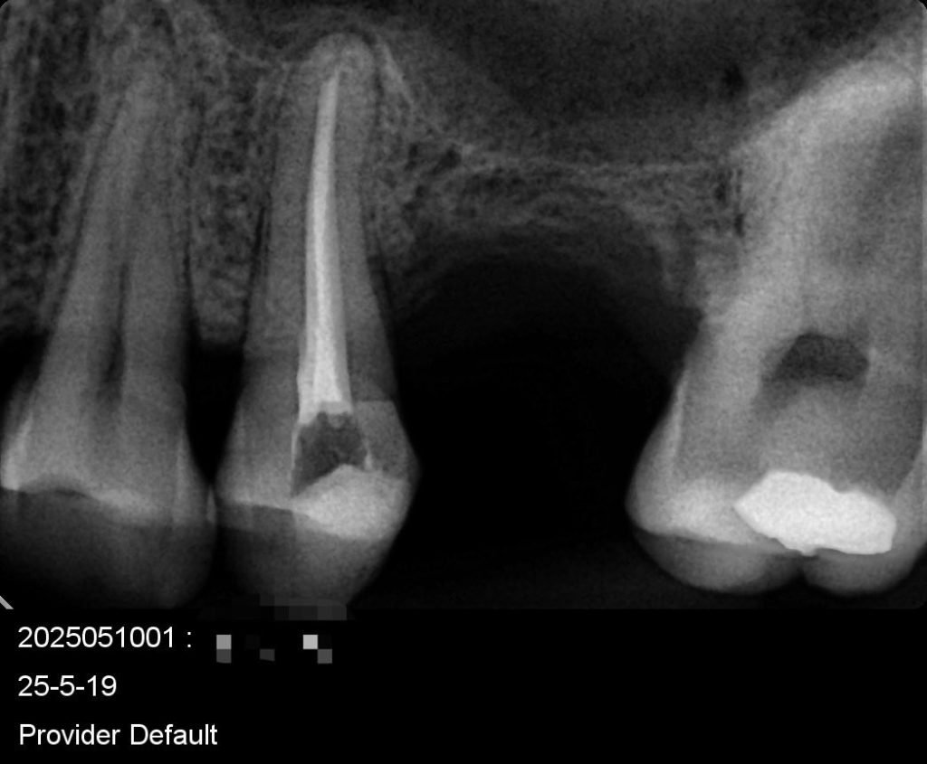 caso clinico endomotor endodoncia