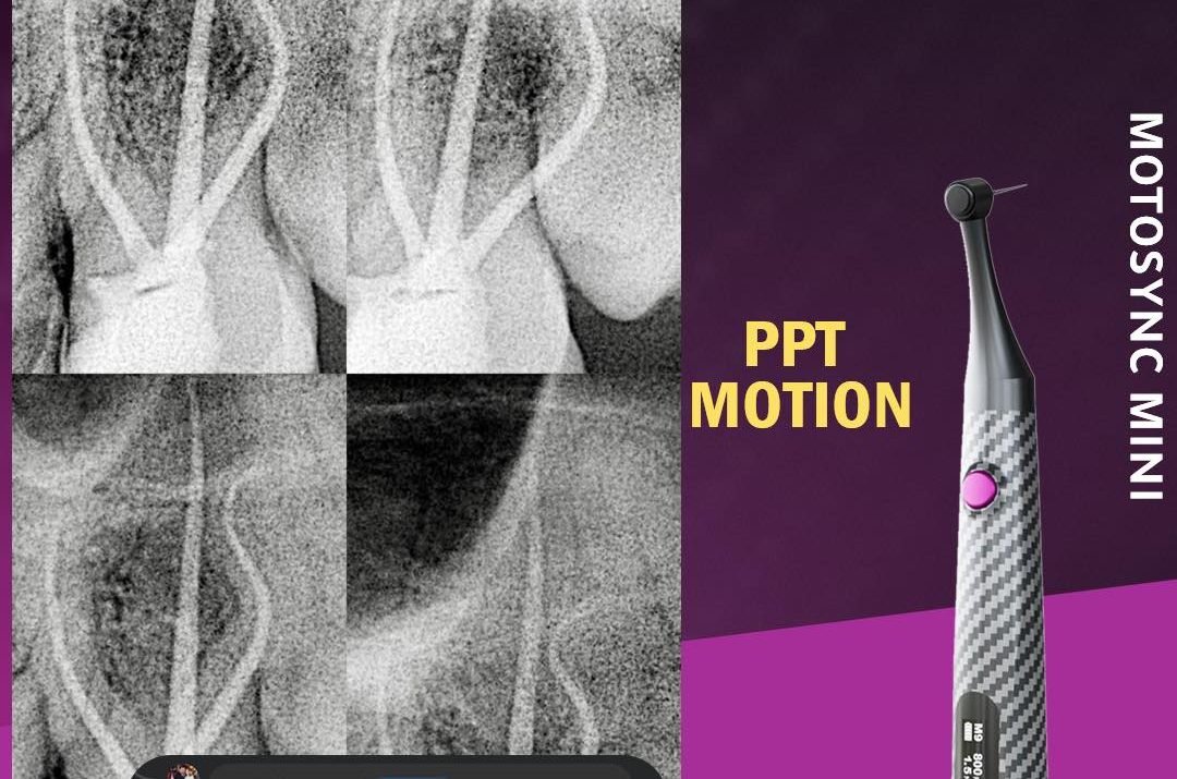 Caso clinico con endomotor Mini MotoSync con el Modo PPT