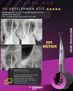 Caso clinico con endomotor Mini MotoSync con el Modo PPT